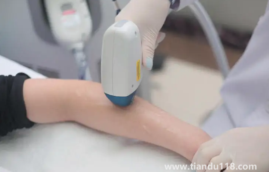 冰點脫毛的具體價格是多少錢（冰點脫毛一次能維持多久）