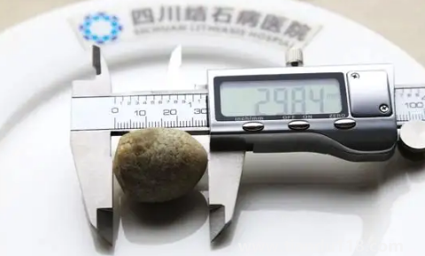 腎結(jié)石3mm需要吃藥嗎(3mm的腎結(jié)石會(huì)尿血嗎)(圖2) 腎結(jié)石3mm需要吃藥嗎2