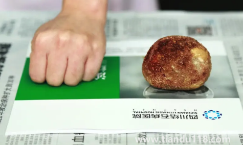 腎結(jié)石3mm需要吃藥嗎（3mm的腎結(jié)石會尿血嗎）