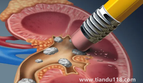 腎結(jié)石3mm需要吃藥嗎(3mm的腎結(jié)石會(huì)尿血嗎)(圖3) 腎結(jié)石3mm需要吃藥嗎3