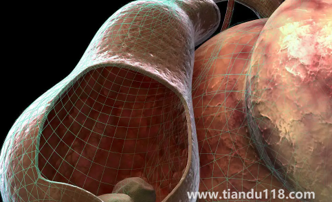 腎結(jié)石三毫米可以碎嗎(三毫米的腎結(jié)石算大的嗎)(圖3) 腎結(jié)石三毫米可以碎嗎3