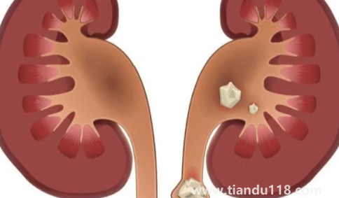 腎結(jié)石3mm×3mm多大(雙腎3×3mm小結(jié)石怎么辦)(圖2) 腎結(jié)石3mm×3mm多大2
