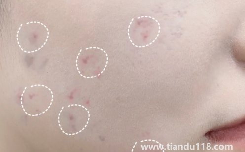 好幾年的痘印還發(fā)紅還能好嗎(皮膚不好有痘印怎么辦)(圖3) 好幾年的痘印還發(fā)紅還能好嗎3